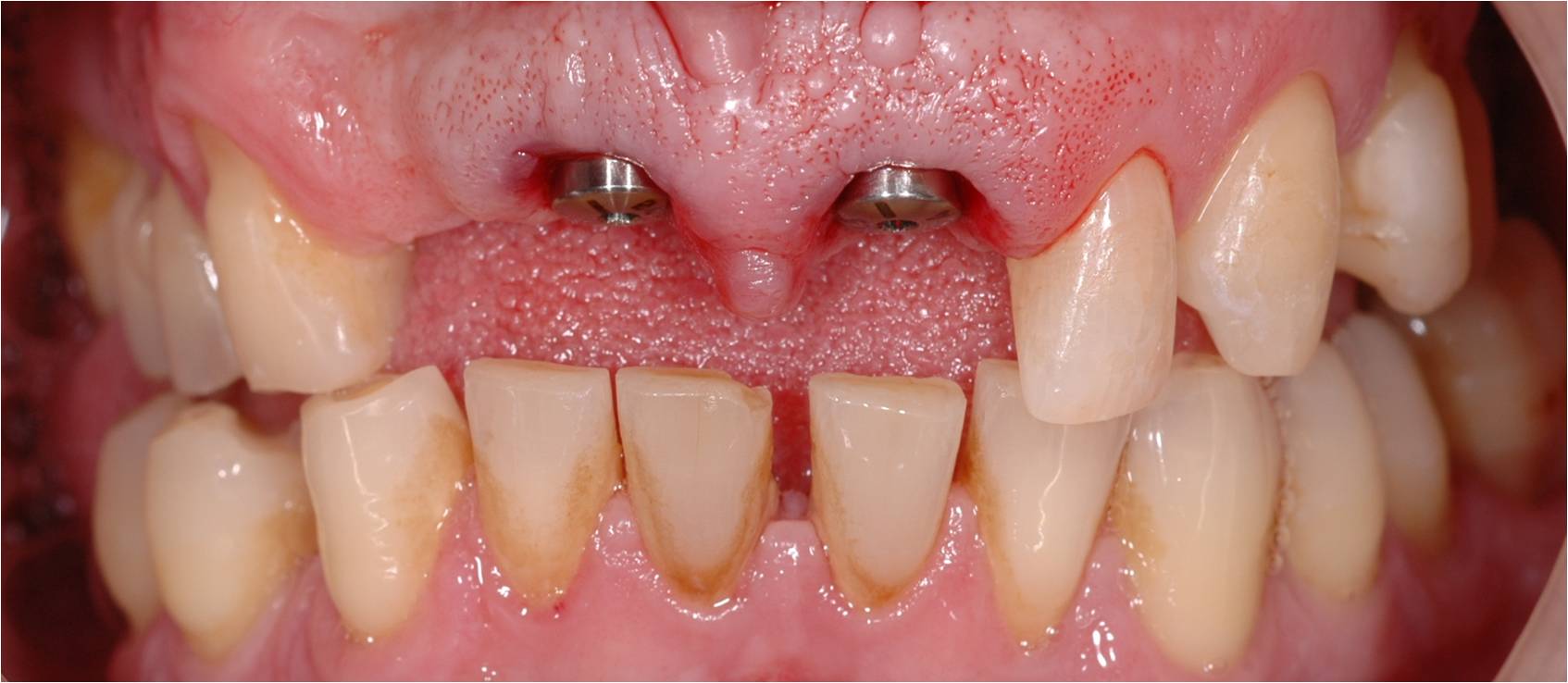 levering Absorberend Scherm Een tand vervangen d.m.v. één implantaat door tandarts Philippe Nuytens